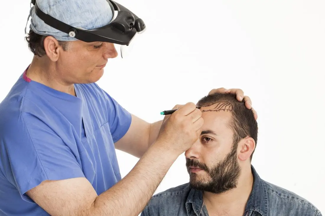 نمونه‌ای از مراحل اولیه کاشت مو با روش FUE