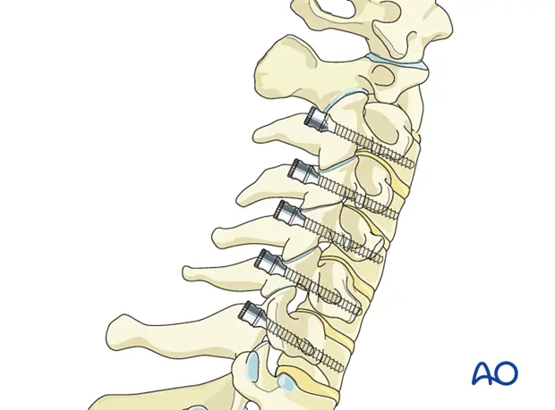 نمونه‌ای از اتصال قطعات فلزی با پیچ و مهره در یک سازه صنعتی