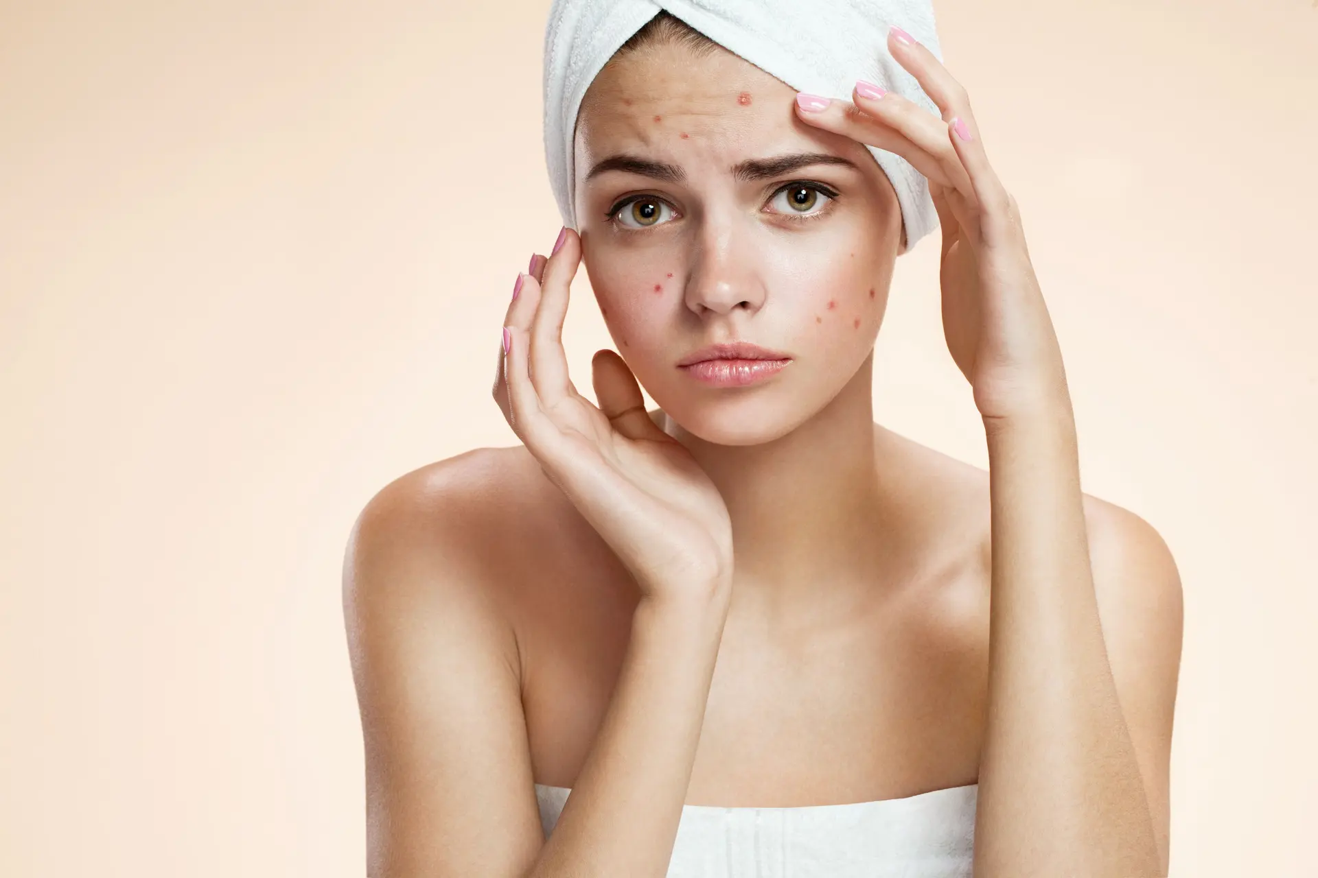 بهترین سرم ضد جوش؛ گزینه‌های مناسب را چطور انتخاب کنیم؟