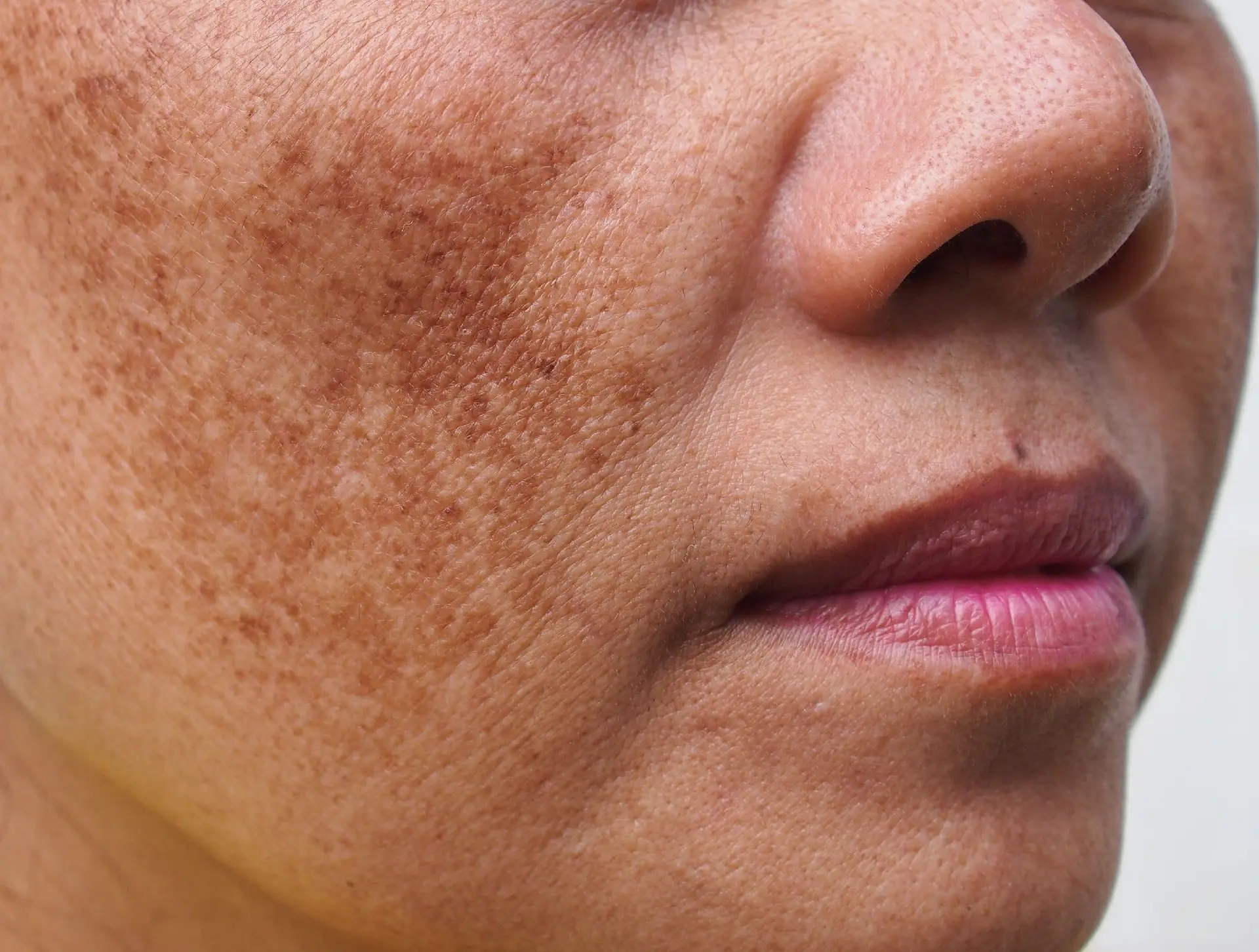 مراقبت‌های پوستی روزانه برای پیشگیری از ملاسما و حفظ سلامت پوست