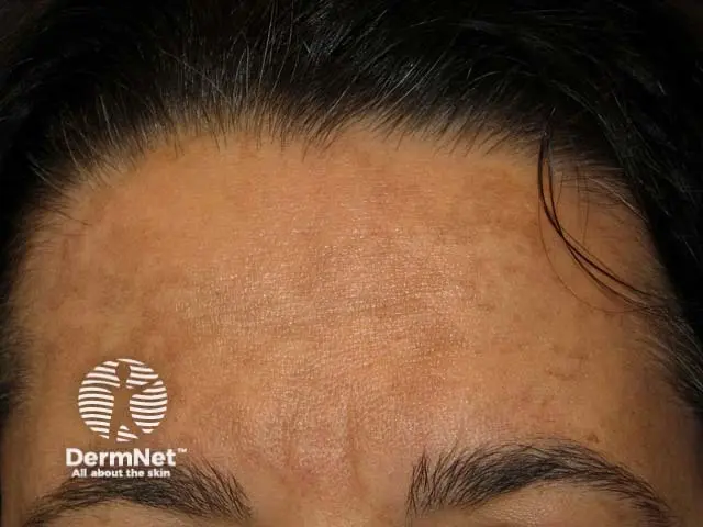 لکه‌های تیره روی صورت که ممکن است نشانه آب سیاه باشند