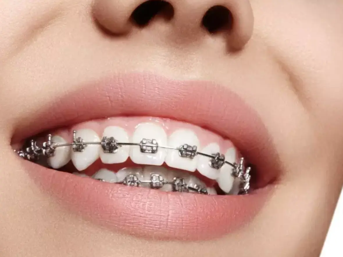 ارتودنسی چیست و چه انواعی دارد؛ پاسخ به پرسش‌های مهم