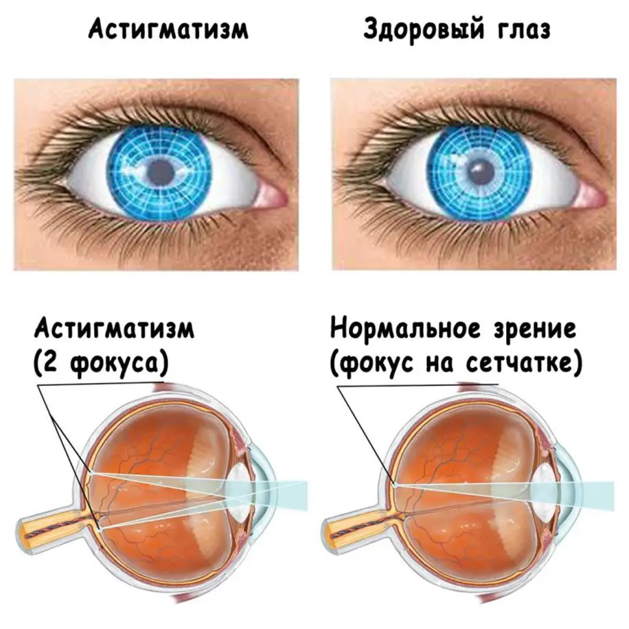 آستیگماتیسم چیست و چه علائمی دارد؛ راهنمای ساده برای شروع