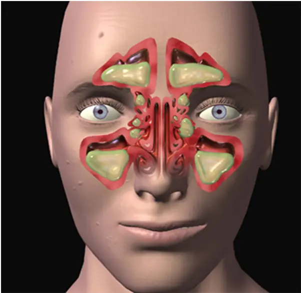 انatomical illustration of human sinuses showing inflammation areas
