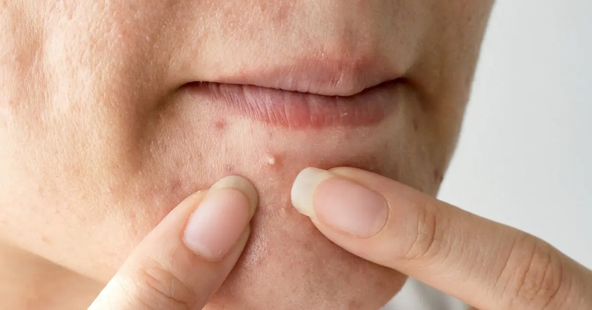 جوشهای کوچک سفید رنگ روی پوست صورت