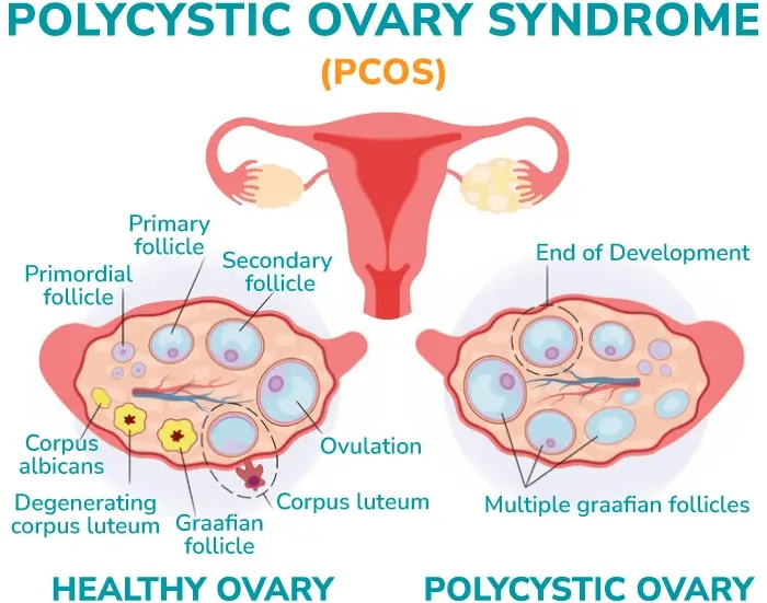 نمونه‌ای از تغییرات پوستی و رشد موهای غیرطبیعی در زنان مبتلا به PCOS