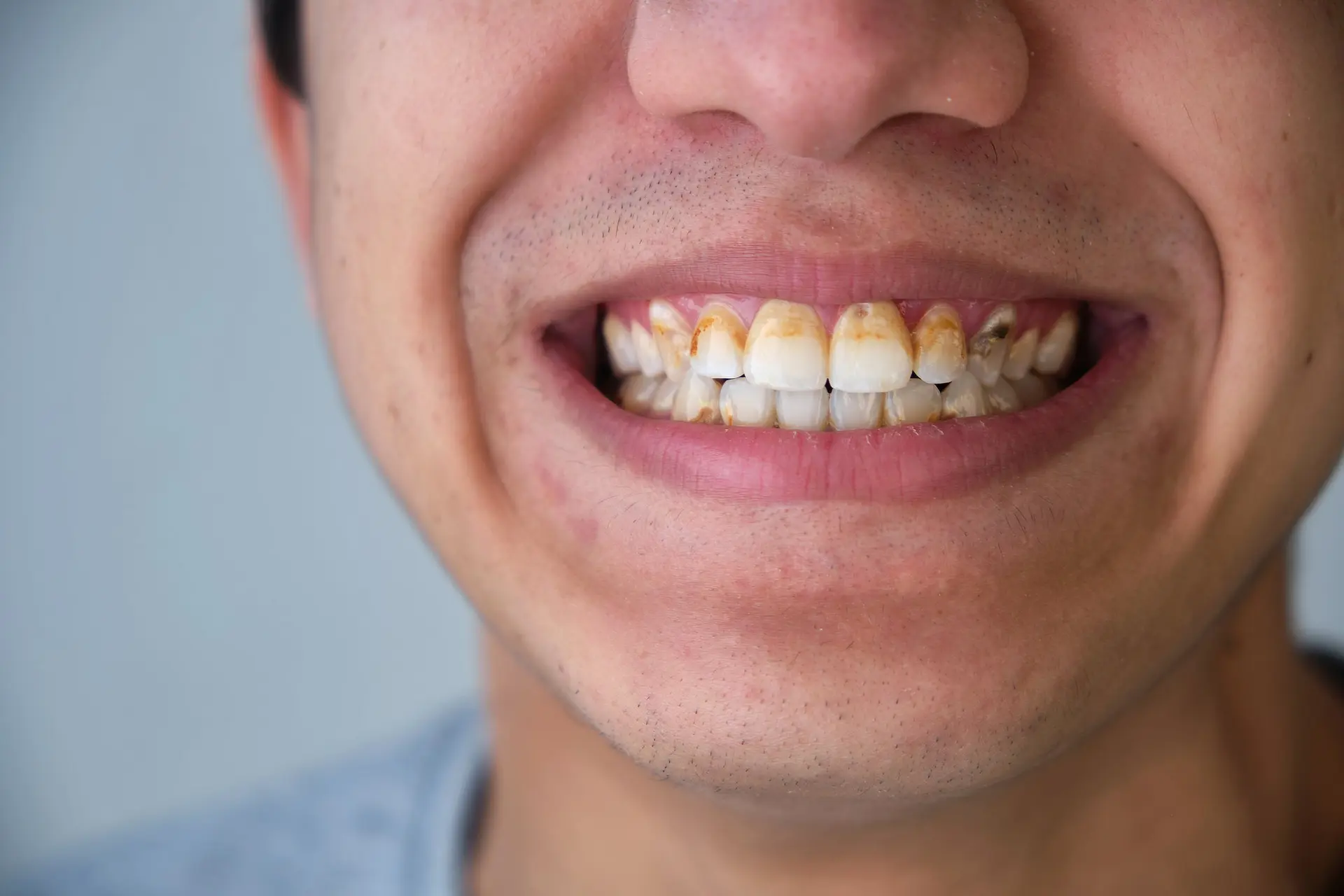 استفاده صحیح از مسواک و نخ دندان برای پاکسازی پلاک
