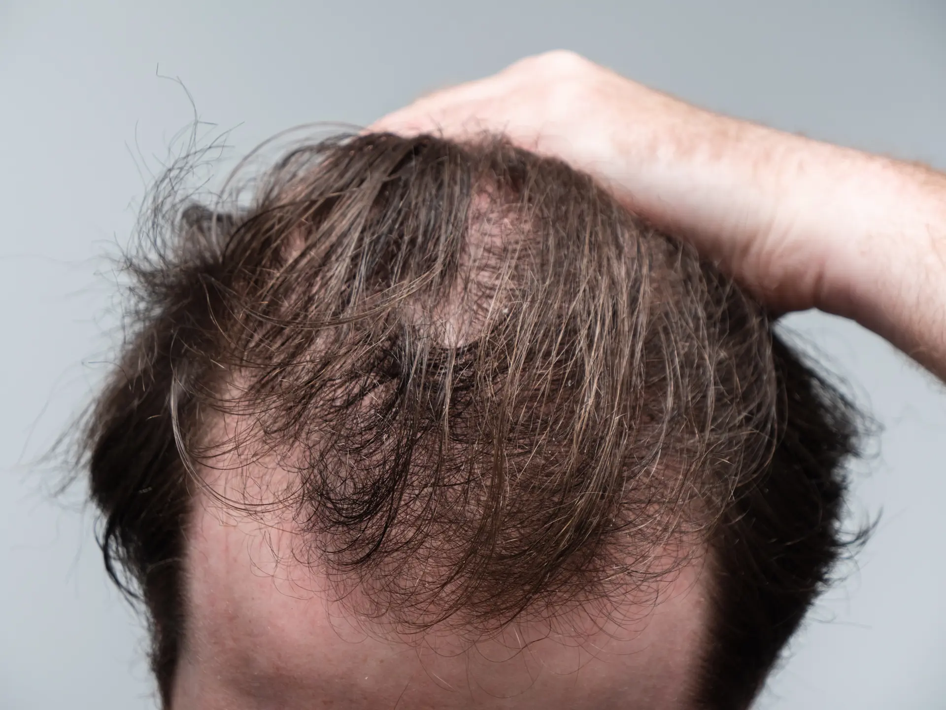 تاثیر استرس و عوامل محیطی بر سلامت مو و پوست سر