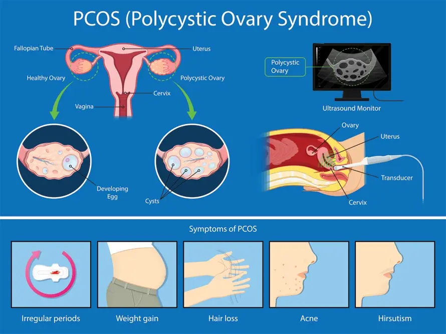 نمایی کلی از ساختار تخمدان در زنان مبتلا به PCOS و تأثیر آن بر هورمون‌ها