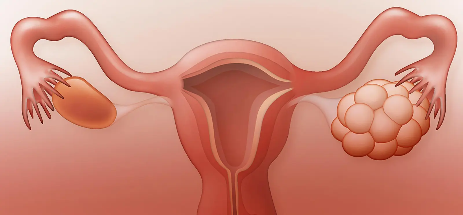 PCOS چیست و چه علائمی دارد؛ راهنمای ساده برای شروع