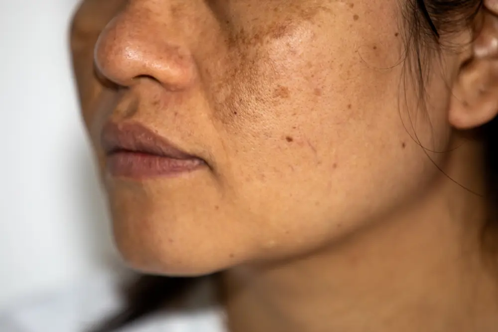 نمونه‌ای از هایپرپیگمنتیشن در ناحیه صورت