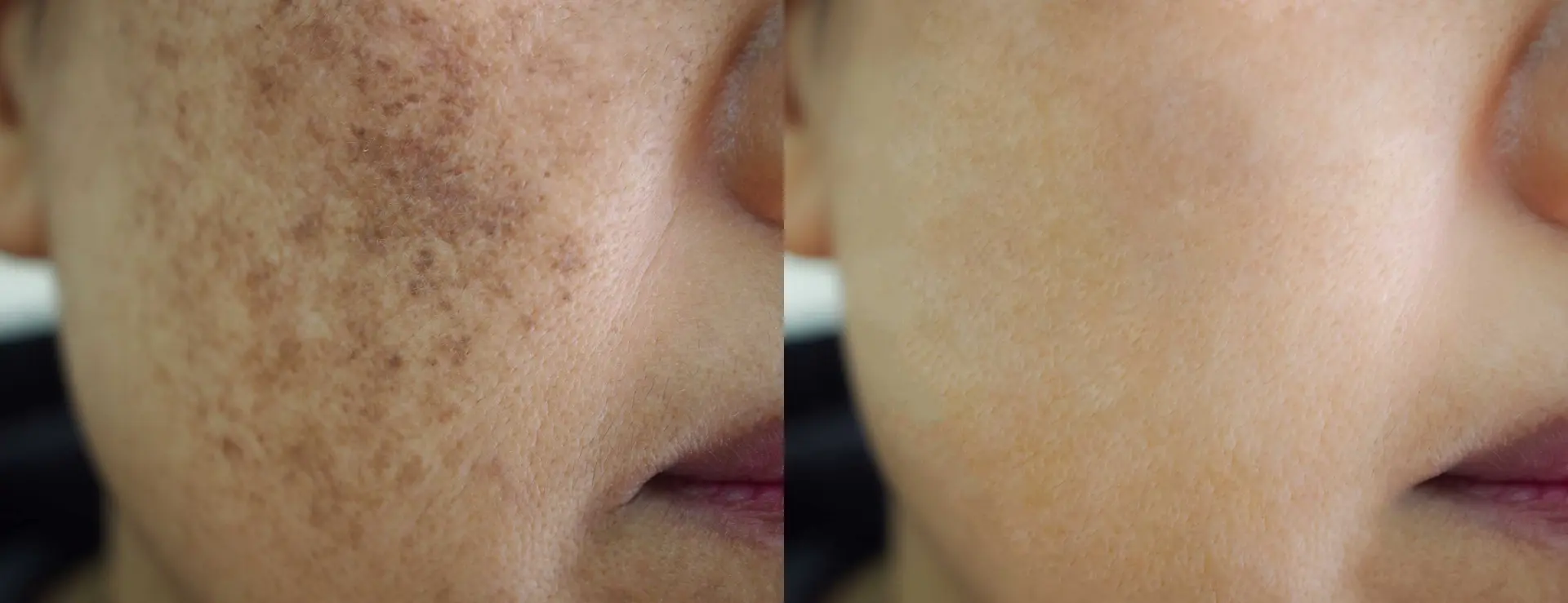 آفتابسوختگی و لکههای تیره روی پوست صورت