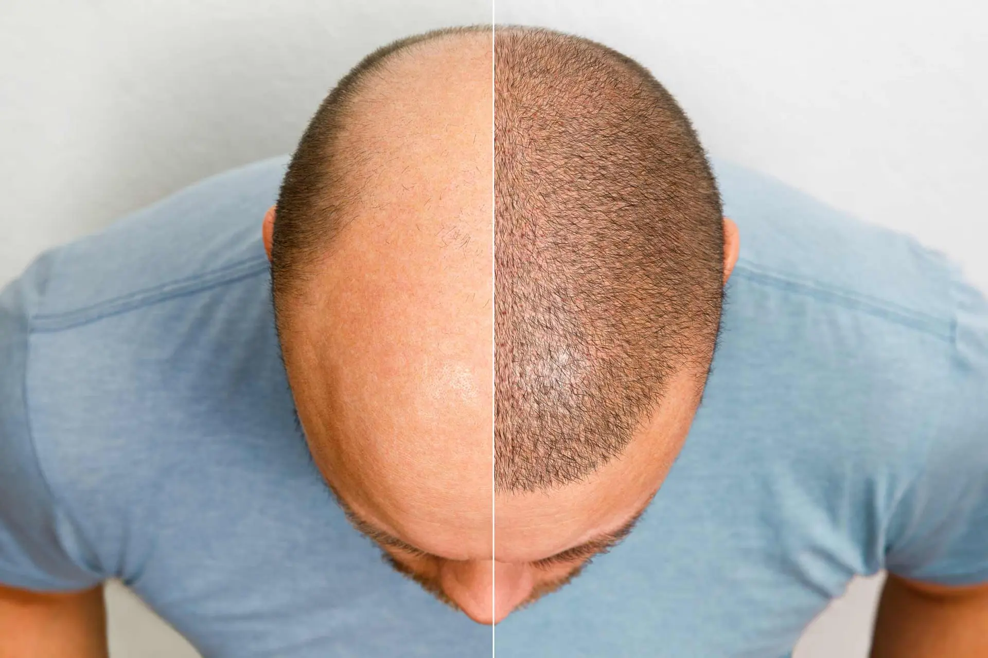 مراحل دقیق کاشت مو با استفاده از تکنیک FUE