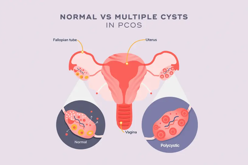 نمونه‌ای از فعالیت‌های ورزشی و رژیم غذایی سالم برای مدیریت PCOS